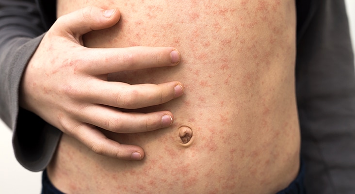 Sick child with red rash spots from measles