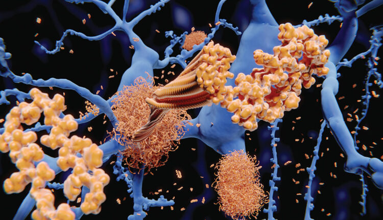 Alzheimer disease
