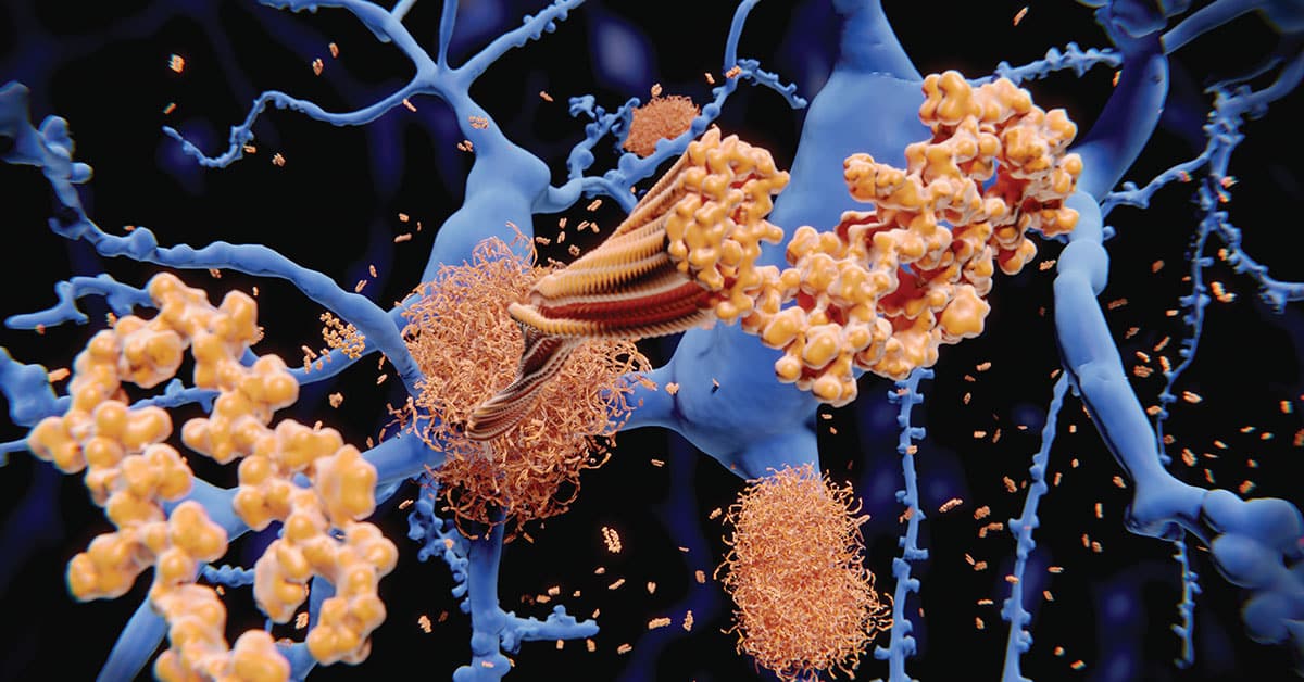 Alzheimer disease