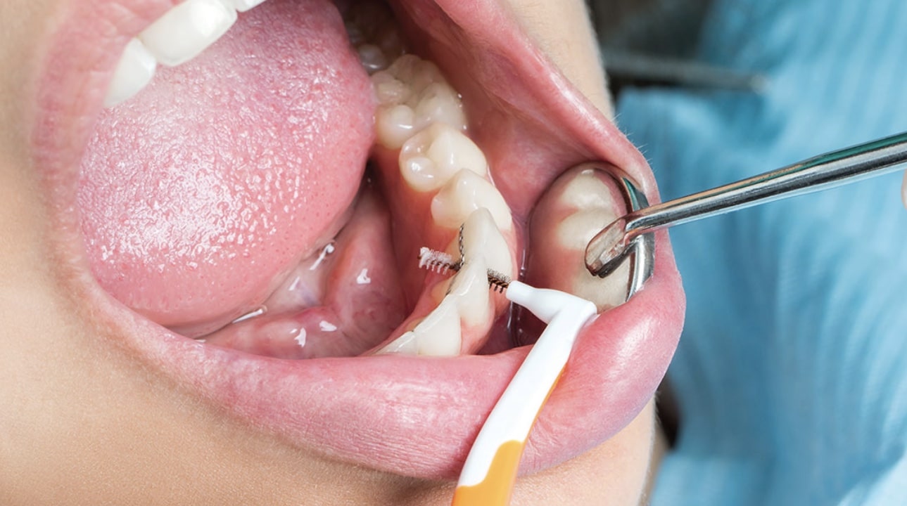 Reduce Oral Disease With Interdental Biofilm Control Dimensions of Dental Hygiene