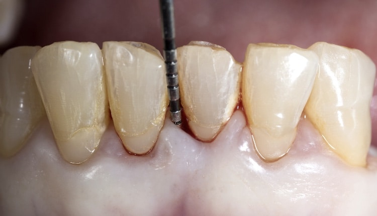 Periodontal probing is a clinical procedure that allows the clinician to estimate the structural status of the periodontal tissues by mechanically probing the gingival sulcus region. Probing depth allows the clinician to make certain assumptions about the state of health of the periodontium.