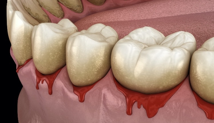 Bleeding gums or Periodontal - pathological inflammatory condition of the gum and bone support. Dental 3D illustration