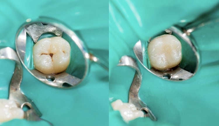 Dental caries. Filling with dental composite photopolymer material using rabbders. The concept of dental treatment in a dental clinic