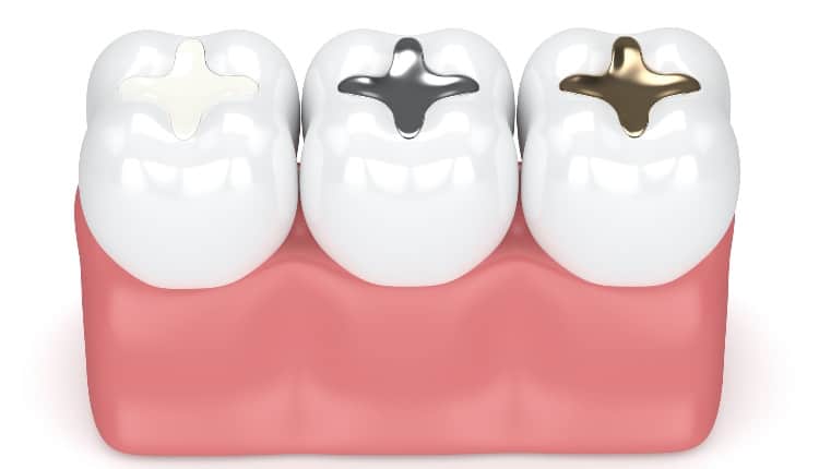 3d render of teeth with different types of dental filling