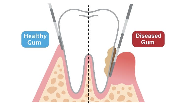 tips-on-periodontal-probing