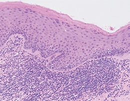 Oral lichen planus