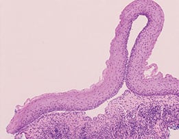 Mucous membrane pemphigoid