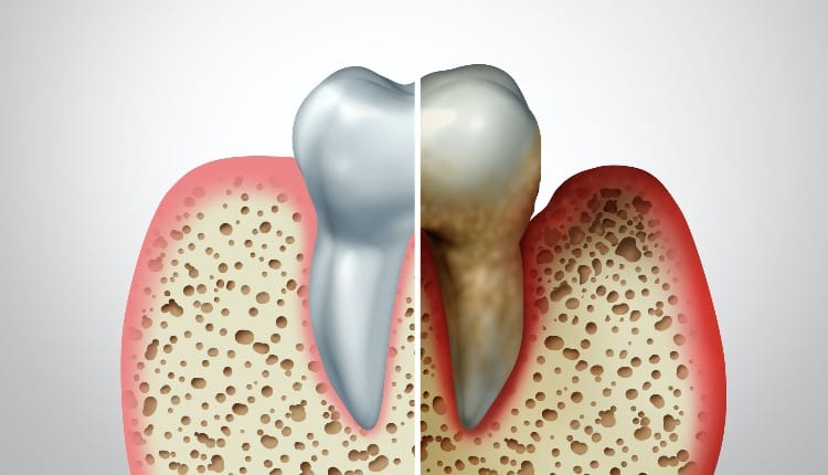 Gum disease comparison with a healthy tooth and an unhealthy one with periodontitis and poor oral hygiene health problem as a bacteria infection diagram concept with inflammation as a 3D illustration.