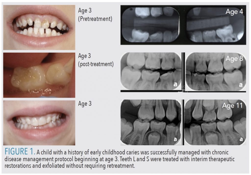 caries figure 1