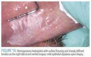 FIGURE 1A. Homogeneous leukoplakia with surface fissuring and sharply defined borders on the right lateral and ventral tongue; mild epithelial dysplasia upon biopsy.