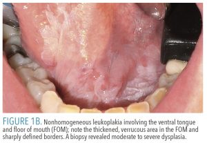 FIGURE 1B.Nonhomogeneous leukoplakia involving the ventral tongue and floor of mouth (FOM); note the thickened, verrucous area in the FOM and sharply defined borders. A biopsy revealed moderate to severe dysplasia.