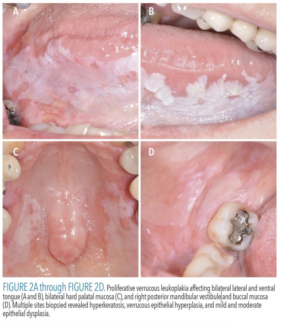 FIGURE 2A throughFIGURE 2D. Proliferative verrucous leukoplakia affecting bilateral lateral and ventral tongue (A and B), bilateral hard palatal mucosa (C), and right posterior mandibular vestibule and buccal mucosa (D). Multiple sites biopsied revealed hyperkeratosis, verrucous epithelial hyperplasia, and mild and moderate epithelial dysplasia.