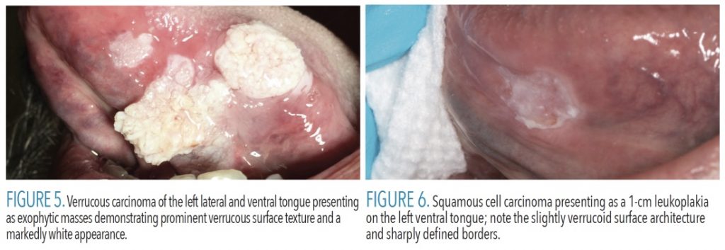 FIGURE 5.Verrucous carcinoma of the left lateral and ventral tongue presenting as exophytic masses demonstrating prominent verrucous surface texture and a markedly white appearance. FIGURE 6.Squamous cell carcinoma presenting as a 1-cm leukoplakia on the left ventral tongue; note the slightly verrucoid surface architecture and sharply defined borders.