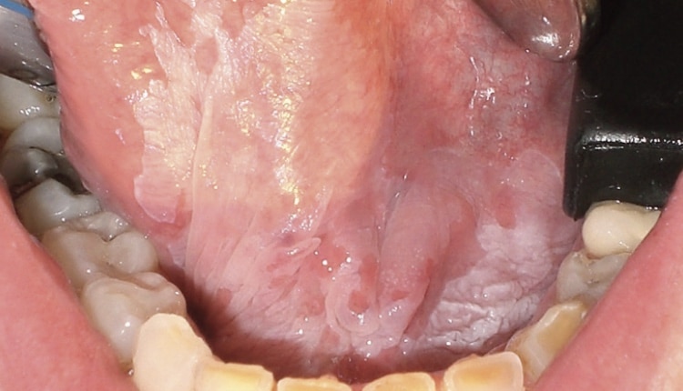 erythroplakia floor of mouth