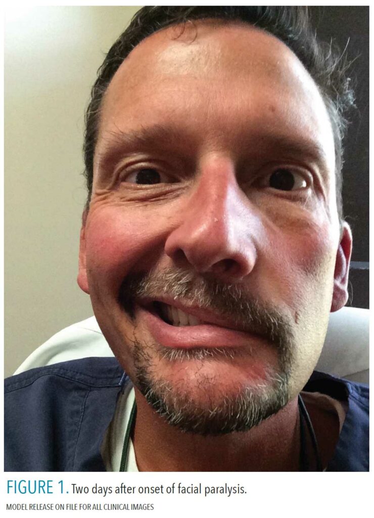 Facial Paralysis