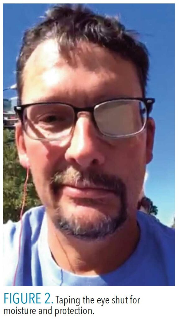 Facial Paralysis