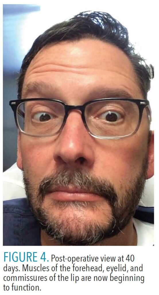 Facial Paralysis