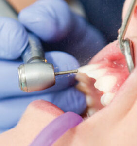 Dental drill