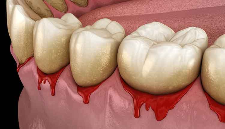 bleeding gums