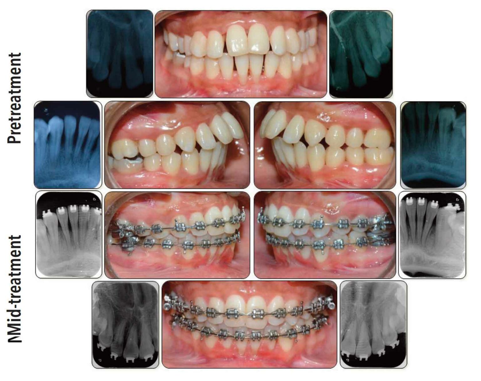 Considering Combined OrthodonticPeriodontic Treatment Dimensions of