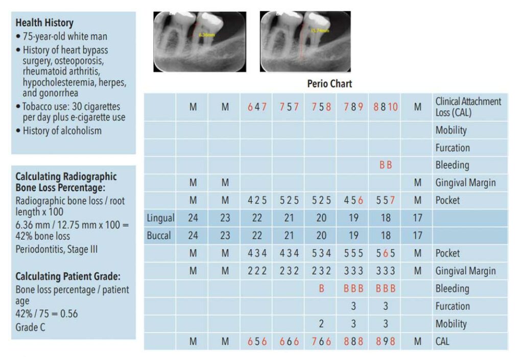 Applying the 2017 American Academy of Periodontology’s Periodontal Classification Guidelines in Professional Practice