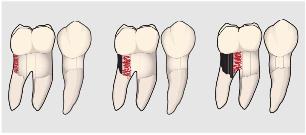 FIGURE 1.Ultrasonic scaling technique must be as meticulous as hand instrumentation technique. The use of overlapping strokes confined to vertical channels across the tooth will ensure thorough coverage.
