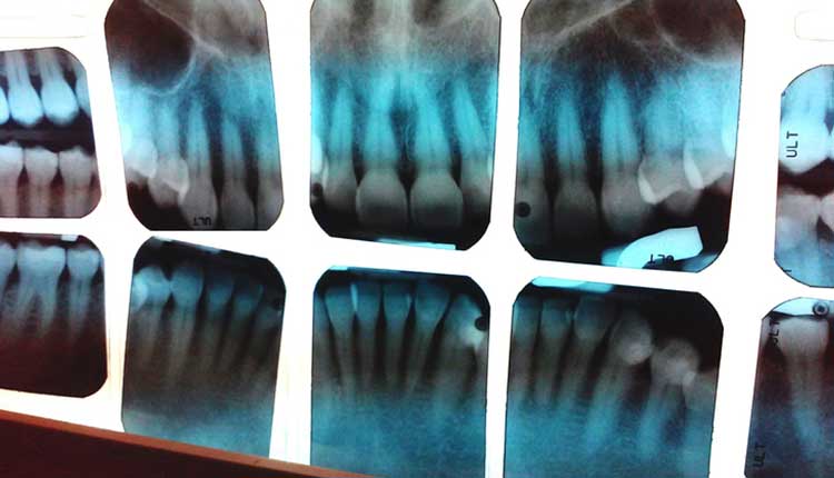 mouth xrays