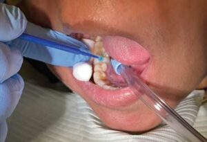 FIGURE 2. Cavity conditioner is applied using a mircobrush.