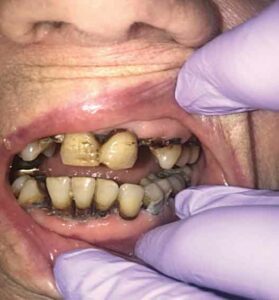 FIGURE 1.Application of silver diamine fluoride.