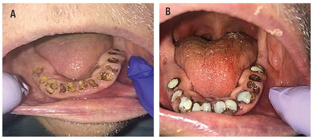 FIGURE 2A andFIGURE 2B. Application of the atraumatic restorative technique (A, B).