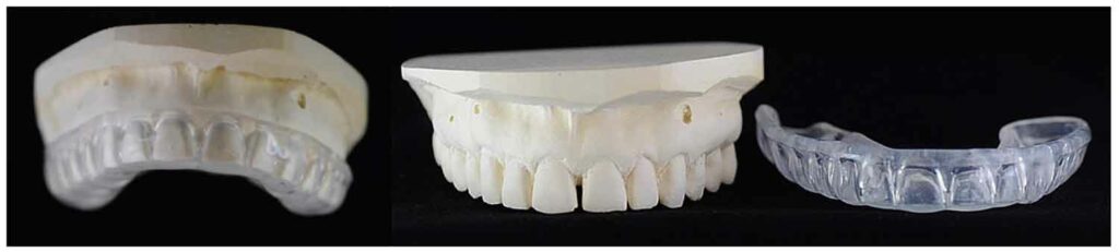 FIGURE 3.Custom fluoride trays.