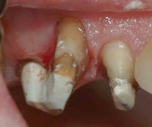 FIGURE 10.Following distal buccal root resection, the previous Class II furcation involvement has been eliminated.