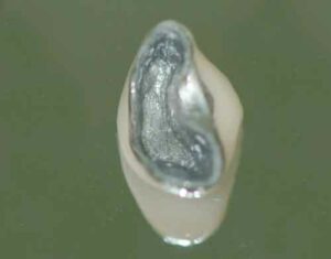 FIGURE 11.Aview of the underside of the casting demonstrates the differential tooth preparation used in the area of root resection and odontoplasty.