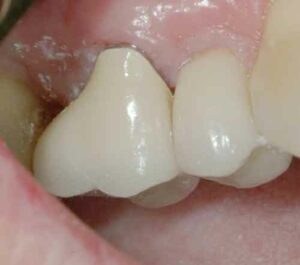 FIGURE 12.The crown has been inserted. No furcation involvement remains.