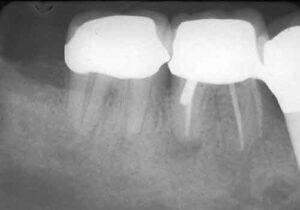 FIGURE 13.The first molar demonstrates a vertical intrafurcal fracture.