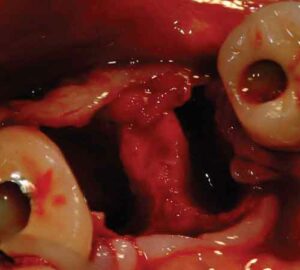 FIGURE 14.Following flap reflection, the first molar has been extracted, and the interradicular bone has been maintained.