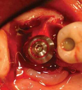 FIGURE 15.An implant has been ideally positioned in the interradicular bone using a differential pressure osteotomy technique.