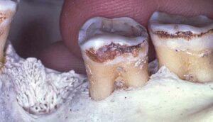 FIGURE 1.Both molars present with Class I horizontal furcation involvements.