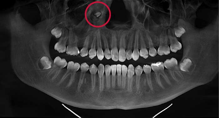 Detecting and Managing Supernumerary and Ectopic Teeth - Dimensions of ...