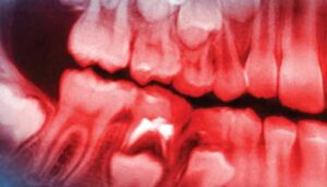 mouth xrays