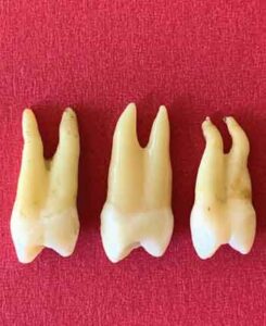 FIGURE 2. Comparison of several maxillary first bicuspids to illustrate the variation in root morphology.