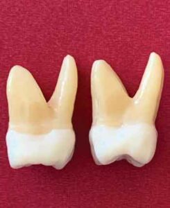 FIGURE 3. The mesial furcation entrance of the maxillary first molar positioned to the palatal (left) and distal furcation entrance in the middle of the tooth (right).