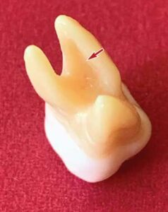 FIGURE 4. The internal concavity on the mesial buccal root of the maxillary first molar.