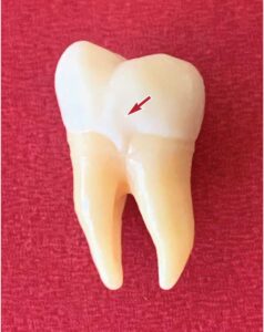 FIGURE 5. Example of an enamel projection on the mandibular first molar.