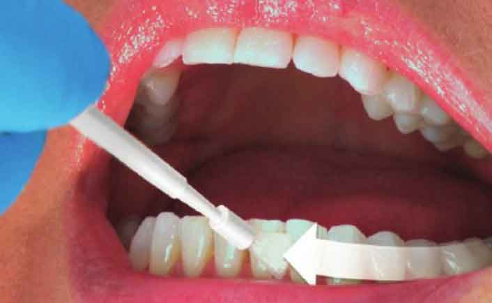 fluoride varnish