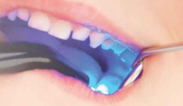 sealant