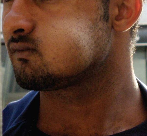 Oral Health Consequences of Khat Use Dimensions of Dental Hygiene