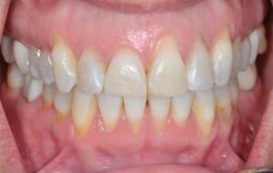 FIGURE 1. The patient presented with multiple gingival recession from teeth #5 to 12.