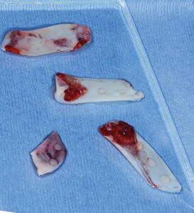 FIGURE 2.Leukocyte platelet-rich fibrin obtained from the patient’s venous blood.