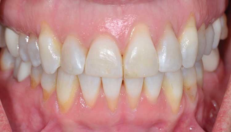 FIGURE 1. The patient presented with multiple gingival recession from teeth #5 to 12.